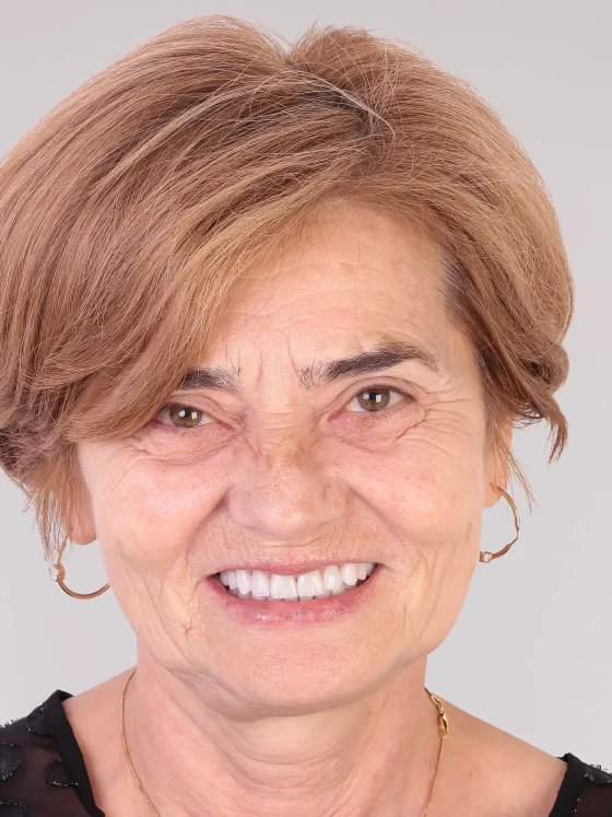 Efect de facelift prin restaurare dentară