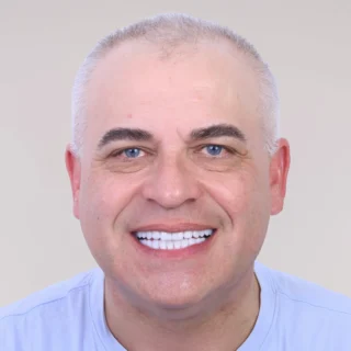 Corectarea Caninilor Incluși Fără Extracții